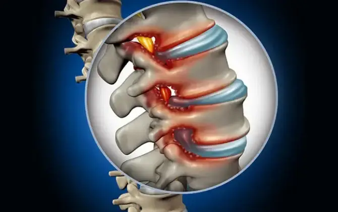 أعراضالانزلاقالغضروفي670x420 | Egypt Chiropractic Center | Egypt Chiropractic Center